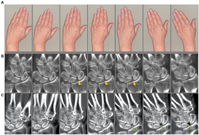 Four-dimensional computed tomography detects dynamic three-dimensional pathologies of the wrist in patients with calcium pyrophosphate deposition disease